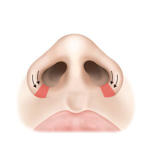 Step 2 reduction design for facial harmony and skin incision for alarplasty