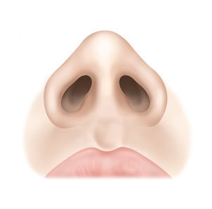 Step 4 narrowed natural nasal tip result after alar reduction at NANA