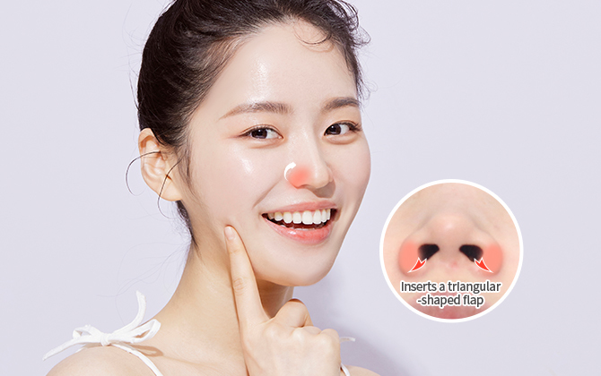 Triangular flap surgery technique for alar reduction without nostril deformation at NANA