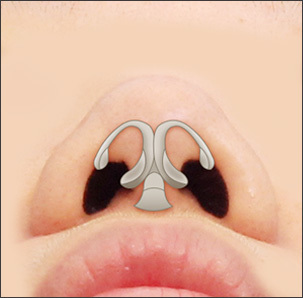 analysis of nasal bone and cartilage structure for rhinoplasty