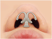 analysis of nasal bone and cartilage structure for rhinoplasty