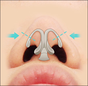 osteotomy process to narrow a wide nasal bridge