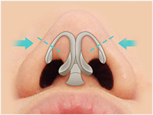 osteotomy process to narrow a wide nasal bridge