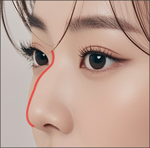 Step 1 pre-surgery 3D-CT scan and specialist consultation for hump reduction at NANA