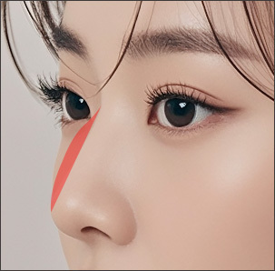 Step 2 dorsal hump removal by trimming or septoplasty of the nasal bridge bone at NANA