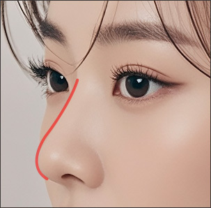 Step 3 nasal bridge height adjustment with filler or autologous cartilage for nasal tip elevation