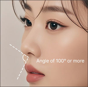 Significant upward nasal tip angle type requiring short nose correction at NANA