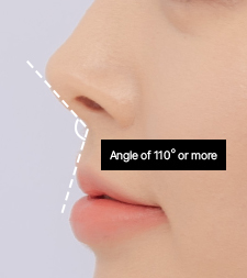 Significant upward nasal tip angle type requiring short nose correction at NANA