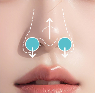 Upturned pig nose type with elevated nostrils requiring short nose correction at NANA
