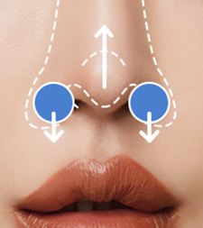 Upturned pig nose type with elevated nostrils requiring short nose correction at NANA