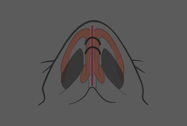 Robust cartilage support structure to lower nasal tip and prevent tip elevation recurrence at NANA